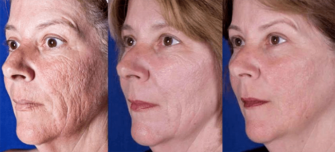 Rezultati pas procedurës së rinovimit të lëkurës në fytyrë me lazer